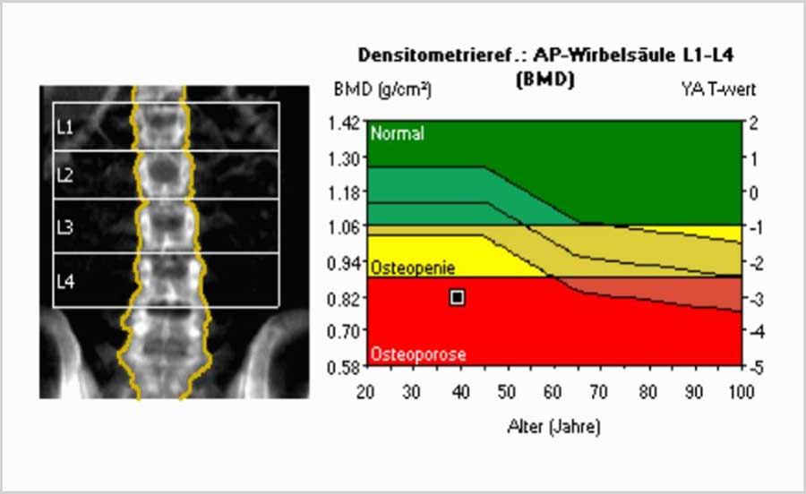 Knochendichtemessung an der Lendenwirbelsäule