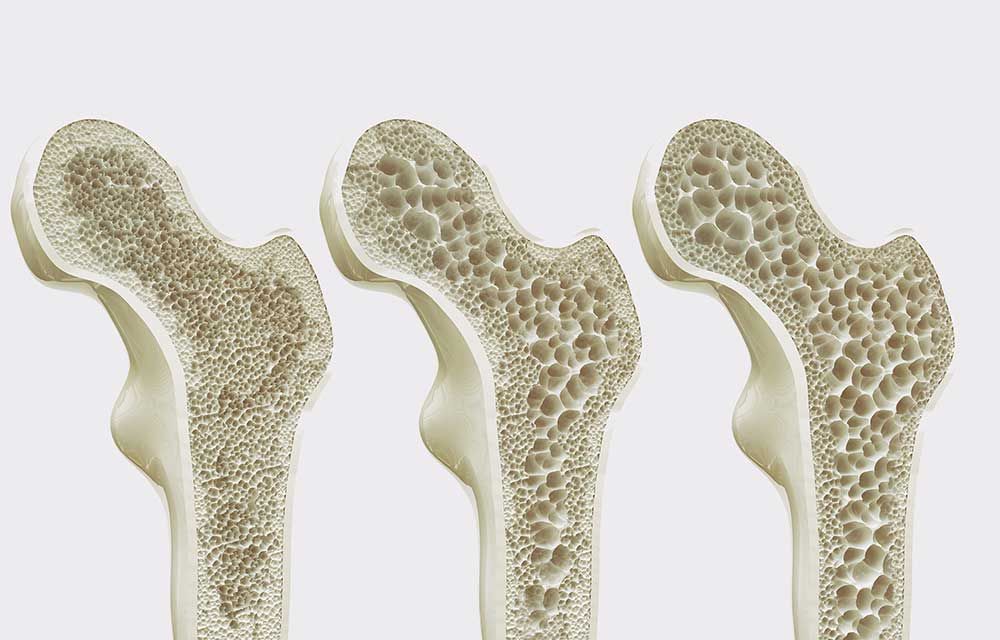 4 Stadien der Osteoporose