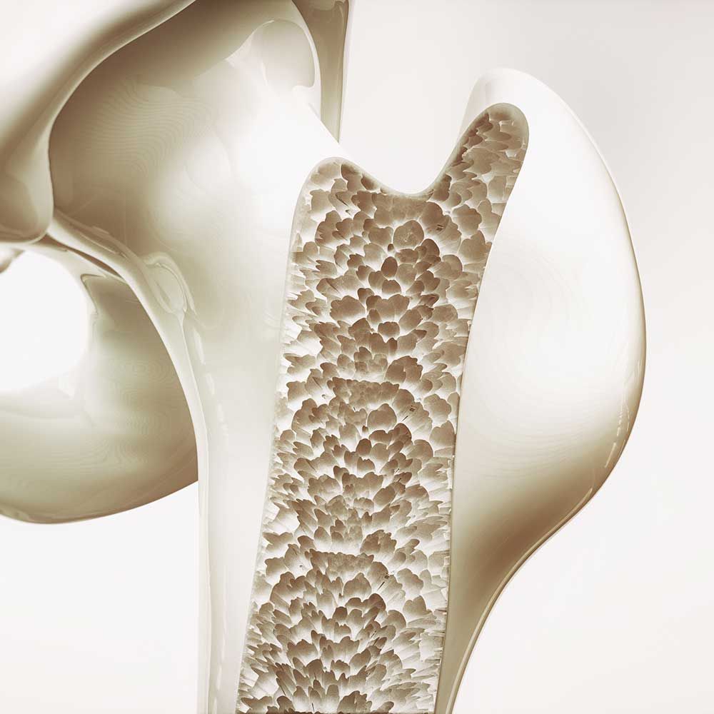 Osteoporose-Stadium-4-von-4---Knochen-der-oberen-Gliedmaen